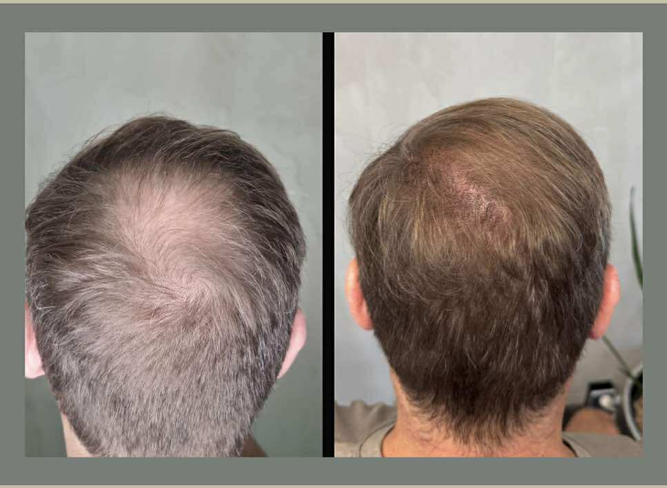scalp micropigmentation before and after