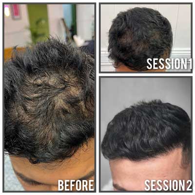 scalp micropigmentation before and after