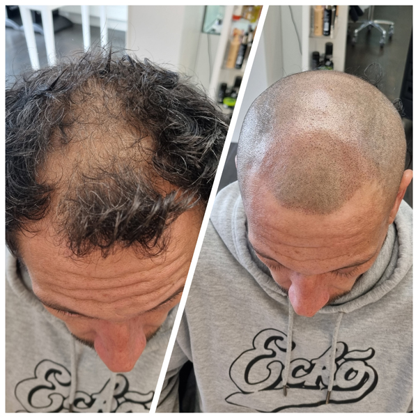 scalp micropigmentation before and after