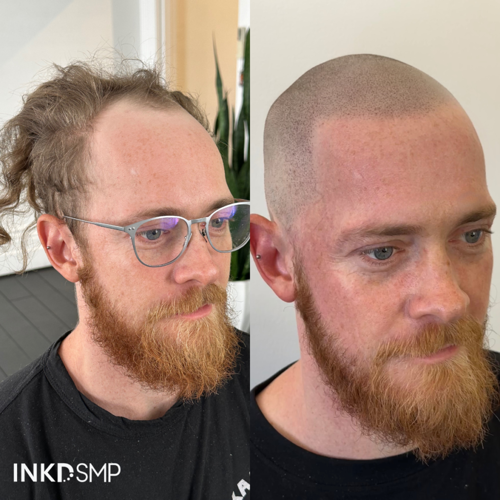 scalp micropigmentation before and after