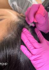 Scalp Micropigmentation (SMP)